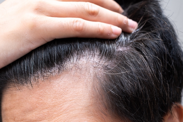 「手遅れ」になる前に!M字ハゲの早期対策