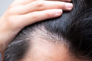 生え際が薄い・後退してきた原因と対策｜今すぐ見直したい習慣と5つのセルフケア