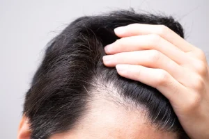 トルコ植毛は「密度」が命！自然な仕上がりになる株数の目安・高密度施術のポイントを解説