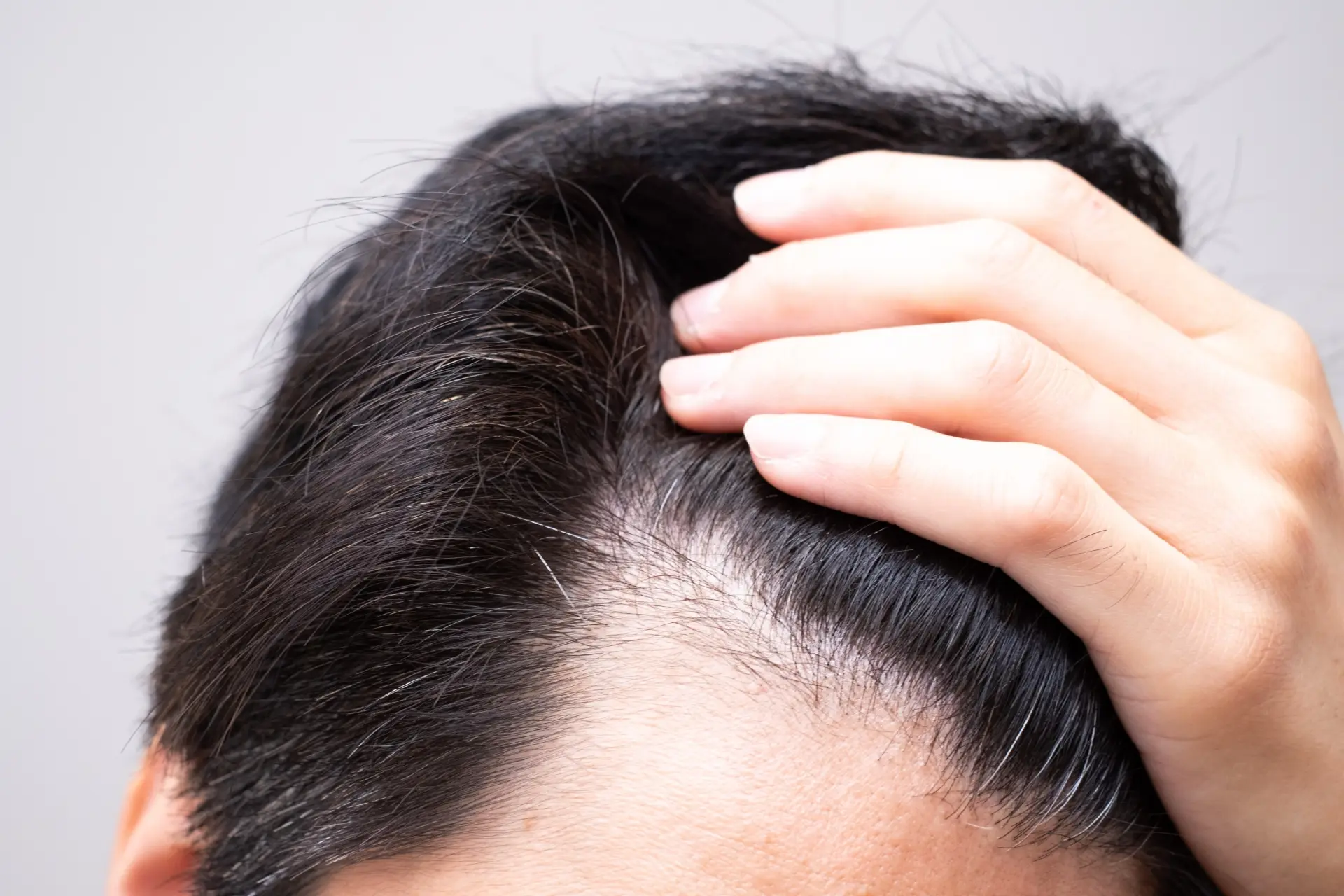 トルコ植毛は「密度」が命！自然な仕上がりになる株数の目安・高密度施術のポイントを解説