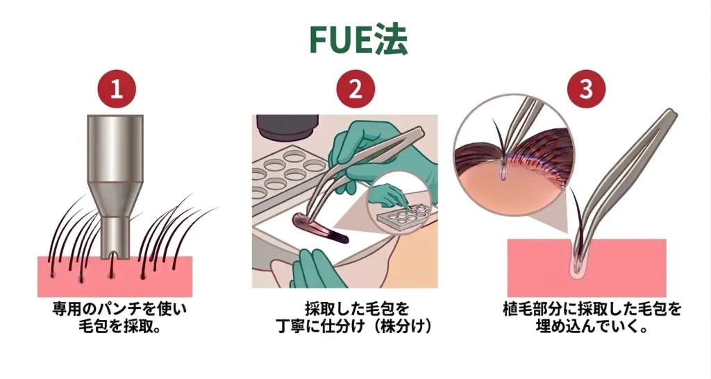 FUE法