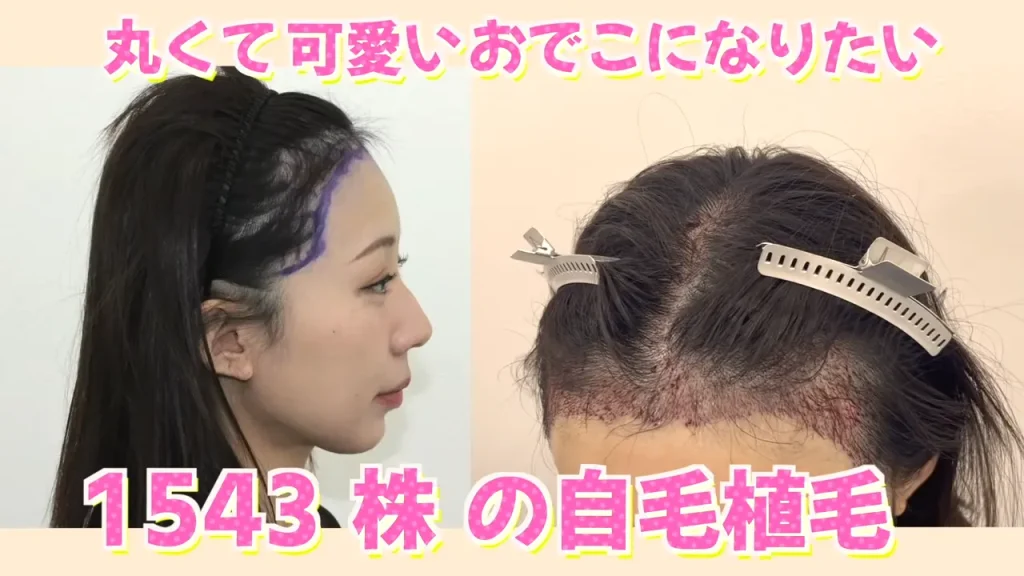 女性の美容植毛（ヘアライン矯正）