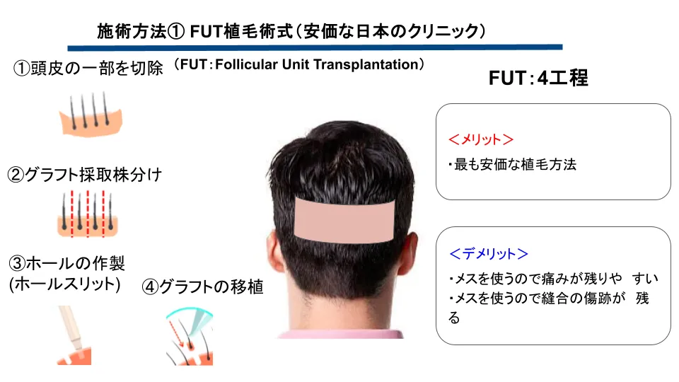 FUT法（切開する植毛）