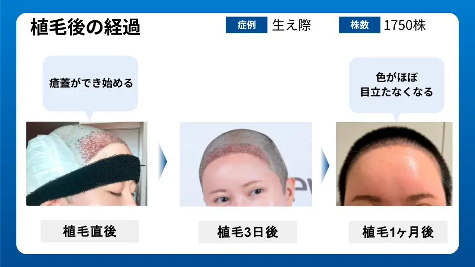 植毛直後から1か月後までの経過資料