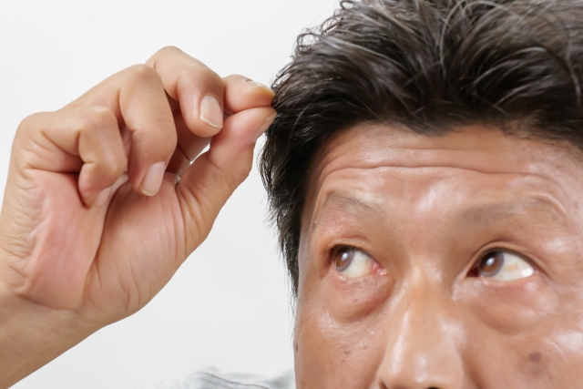 自毛植毛の10年後の見た目はどうなる？