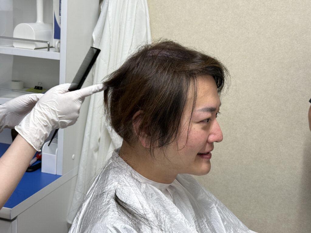林社長が植毛手術のために髪を刈る様子　髪を降ろすと刈った部分が隠せる