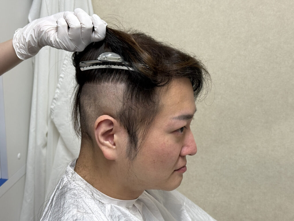 林社長が植毛手術のために髪を刈る様子