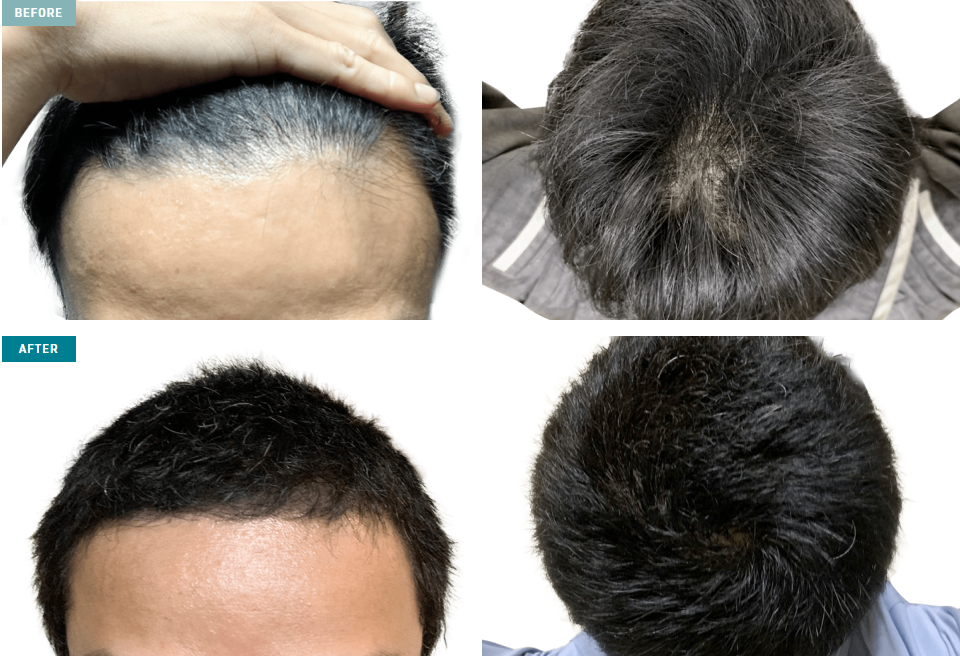 【症例1】広範囲に広がる頭頂部の透け感を改善