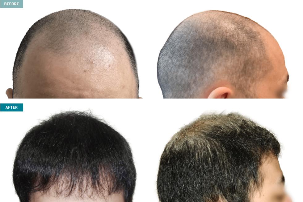 【症例2】頭頂部全体の密度が高まり若々しい印象へ