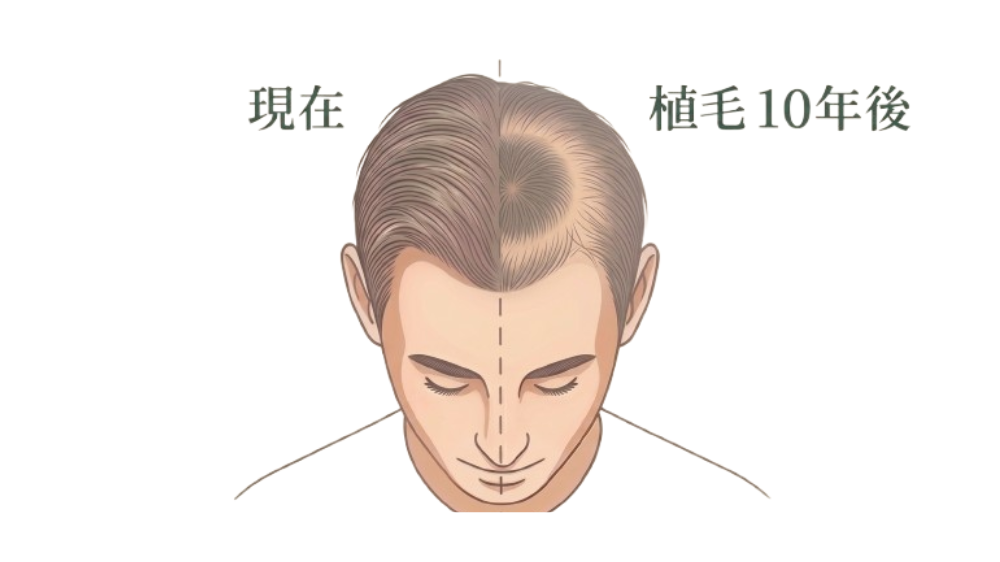 頭頂部に植毛した場合の現在と10年後の比較