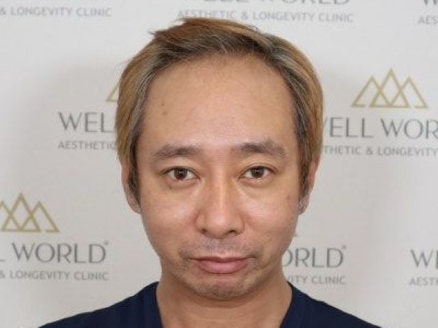 植毛前のいしだ壱成さん