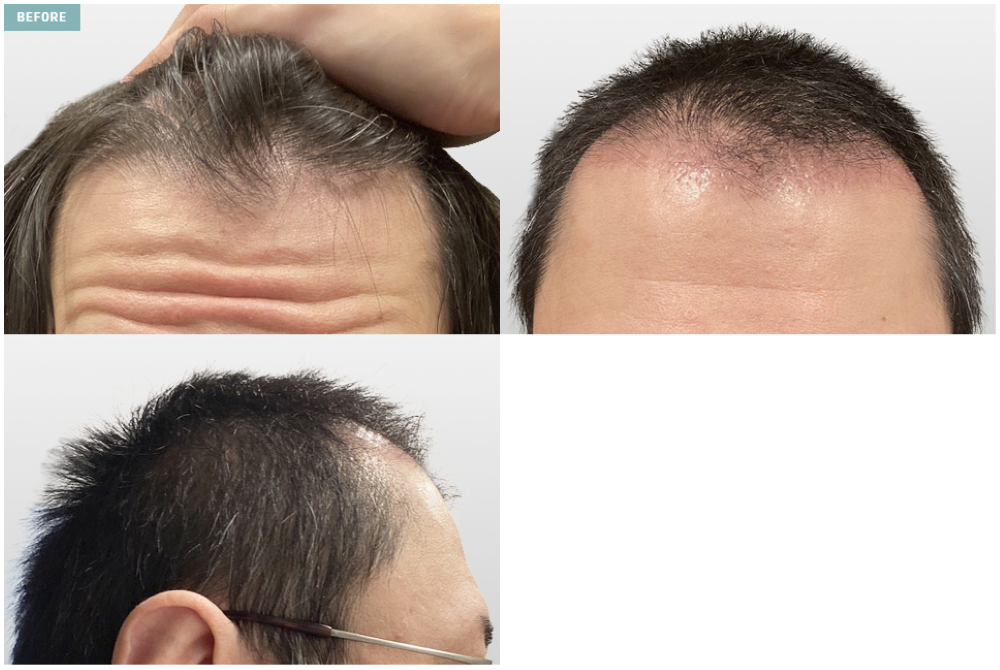 2,500株｜生え際の薄毛を自然にカバーした症例（ビフォー）