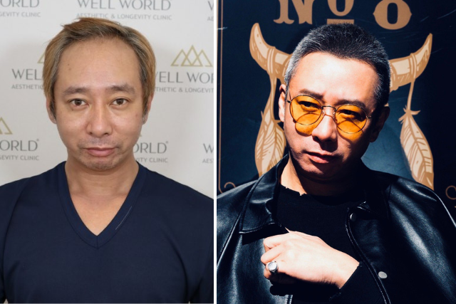いしだ壱成さんの植毛ビフォーアフター