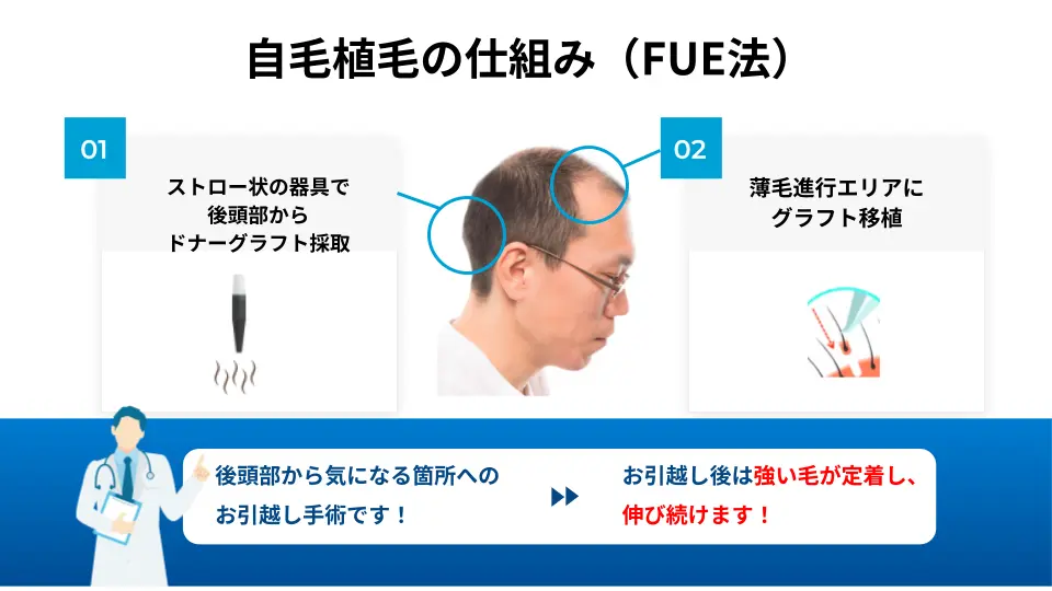 自毛植毛の仕組み（FUE法）