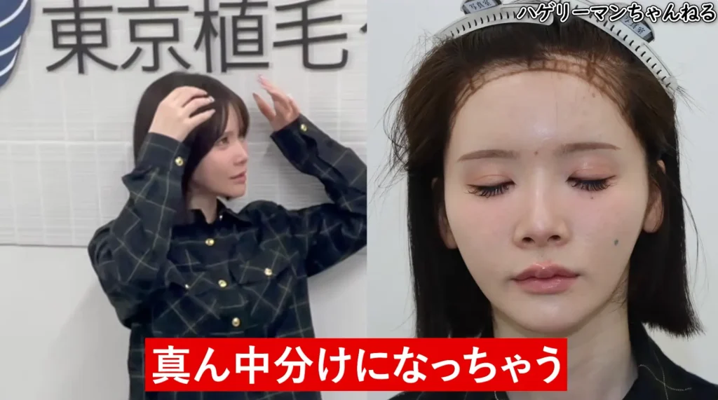 「あおちゃんぺ」さんが植毛を決意した理由とは?