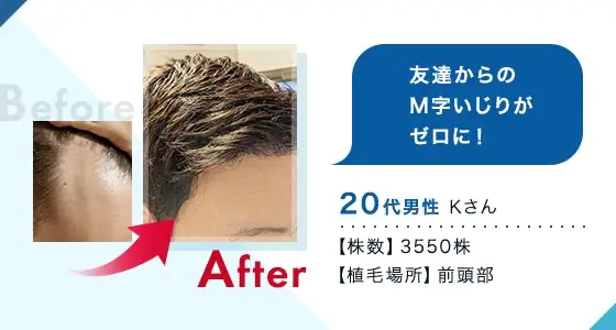 トルコ植毛のビフォーアフター事例②