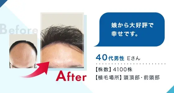 トルコ植毛のビフォーアフター事例④
