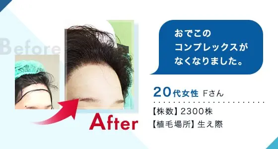トルコ植毛のビフォーアフター事例⑤