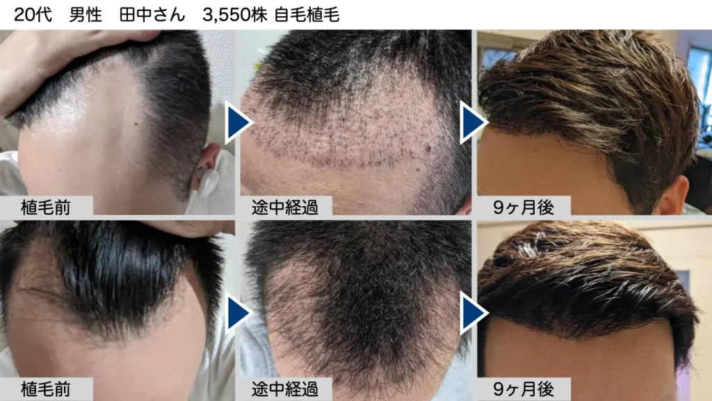 トルコ植毛のビフォーアフター事例⑦
