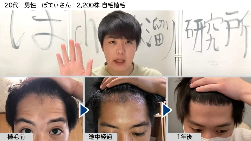 トルコ植毛のビフォーアフター事例⑧