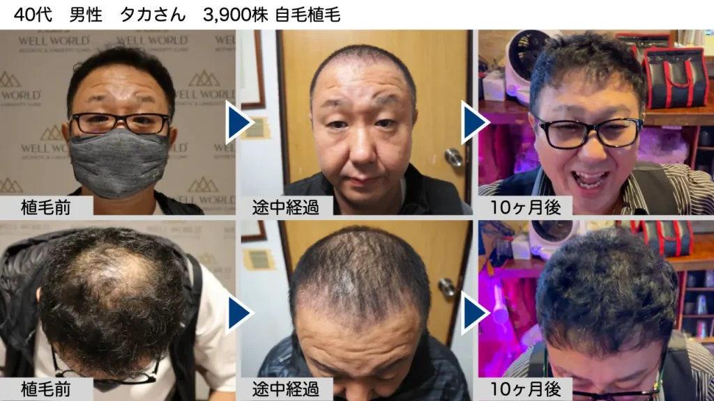 トルコ植毛のビフォーアフター事例⑨