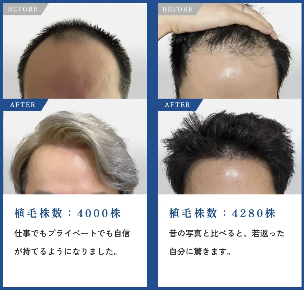 トルコ植毛のビフォーアフター事例⑩〜11