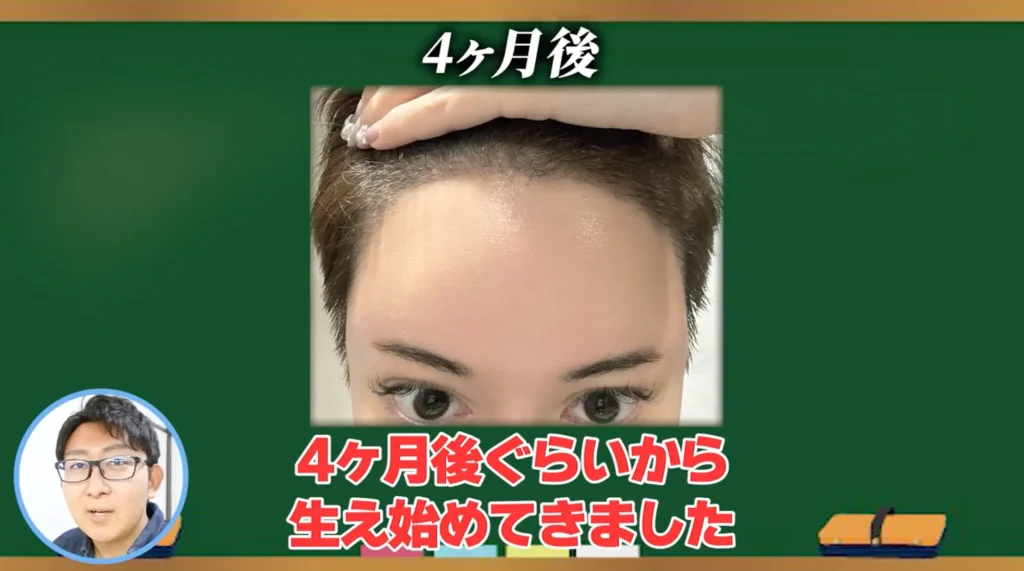 トルコ植毛4ヶ月後に少しずつ発毛が見られる、美容整形ちゃんの生え際