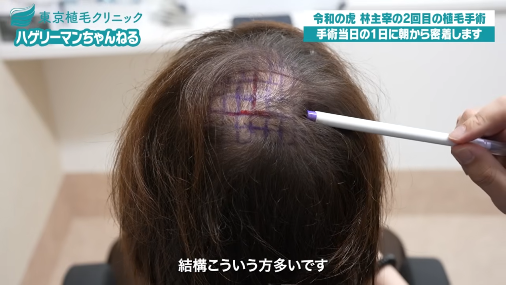 林社長の頭頂部のデザイン設計