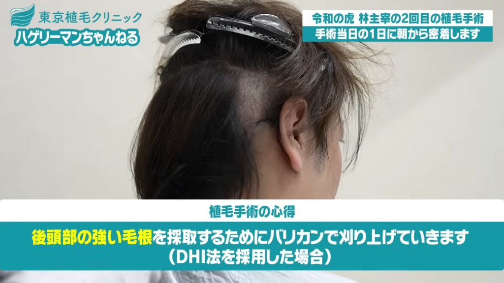 後頭部を刈り上げてドナー採取の準備へ