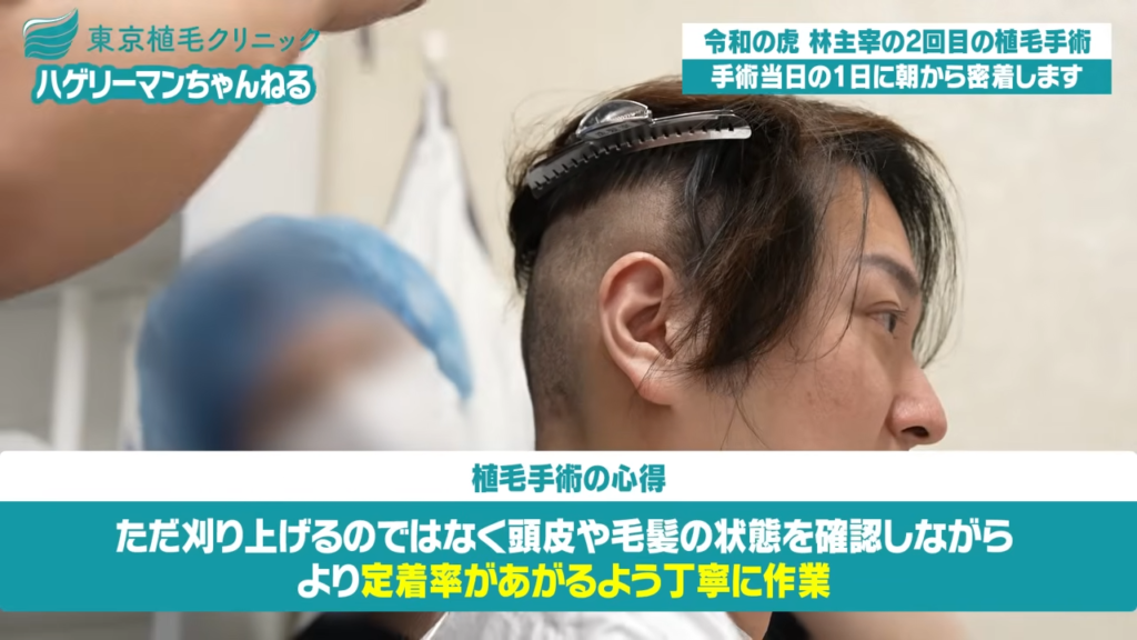 ドナー採取のため後頭部の毛を刈り上げられる林社長
